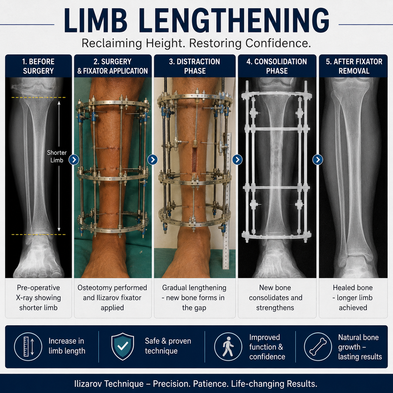 Limb Lengthening Surgery